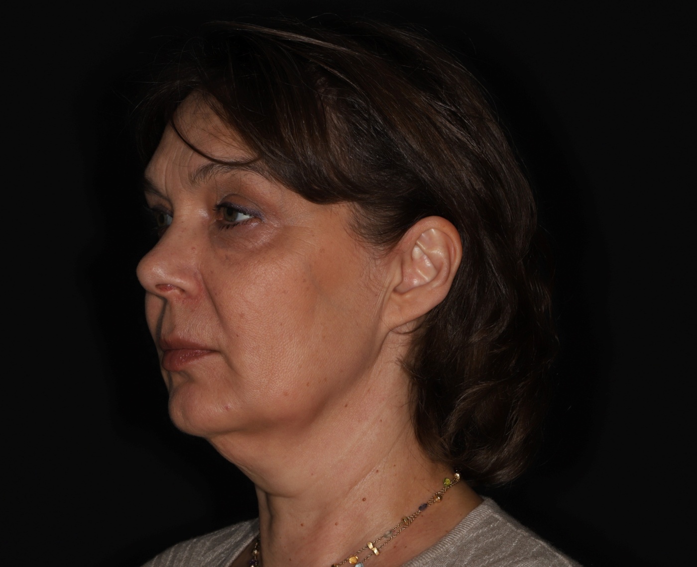 Volume restoration by deep-plane facelift improves also the neck