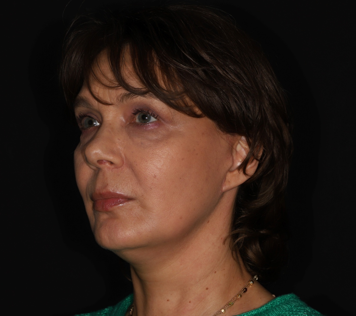 Volume restoration by deep-plane facelift improves also the neck