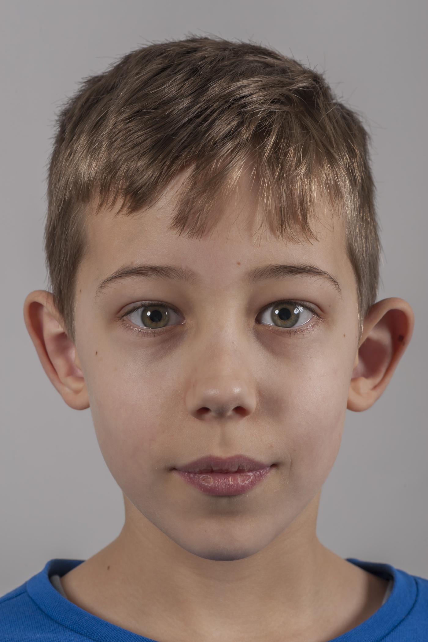 Re-do or secondary ear correction Re-do or secondary ear correction