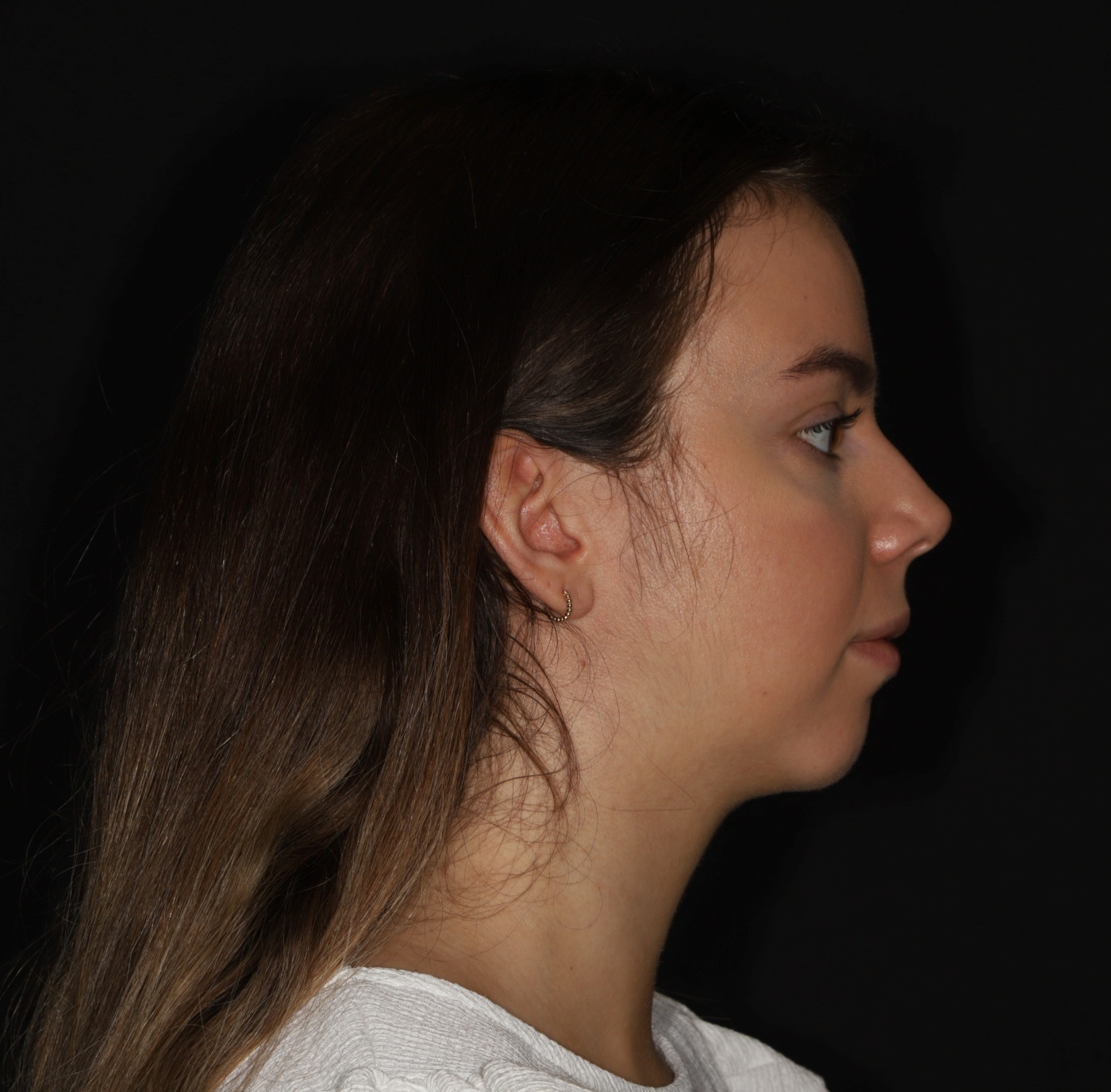 The ratio between the nose and the chin is more balanced after the chin implant