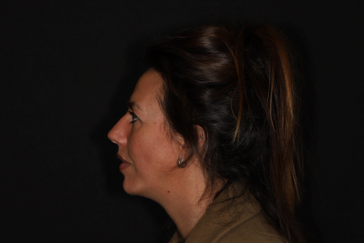 The facial profile is more balanced after the chin implant