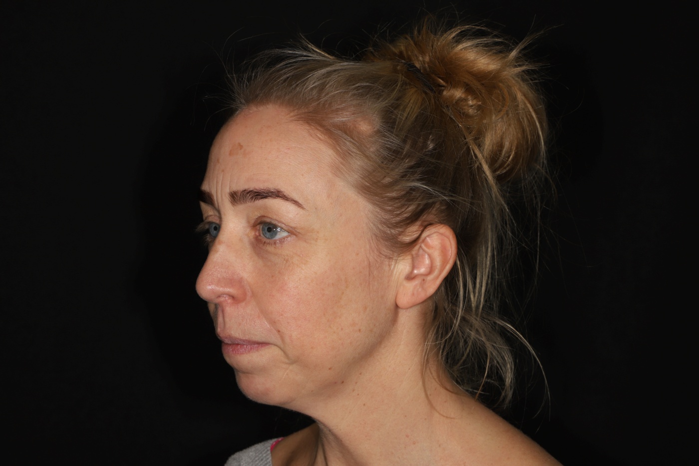 Chin augmentation and correction of the neck