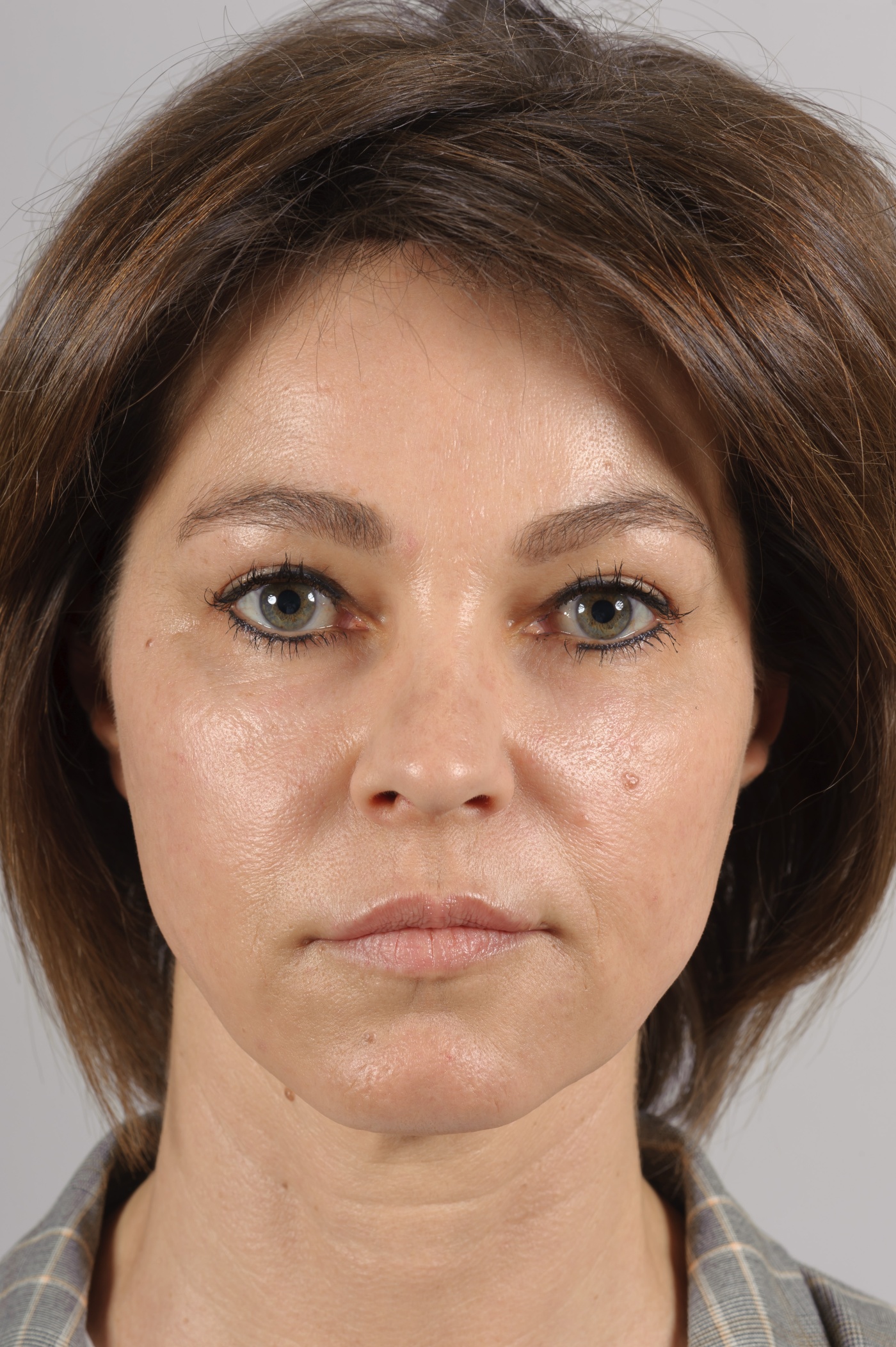 Correction of an angry look by lifting the inner brow