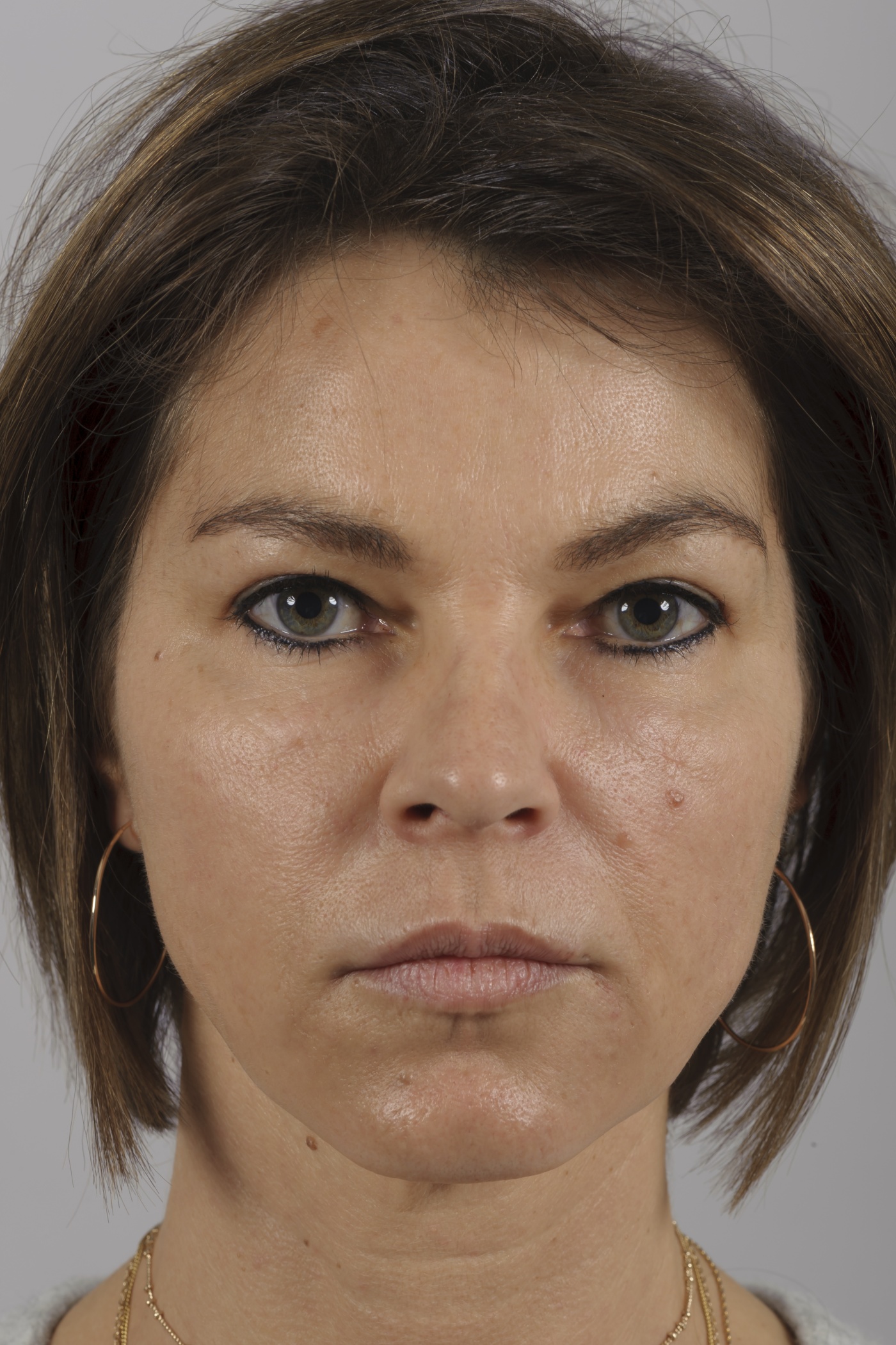 Correction of an angry look by lifting the inner brow