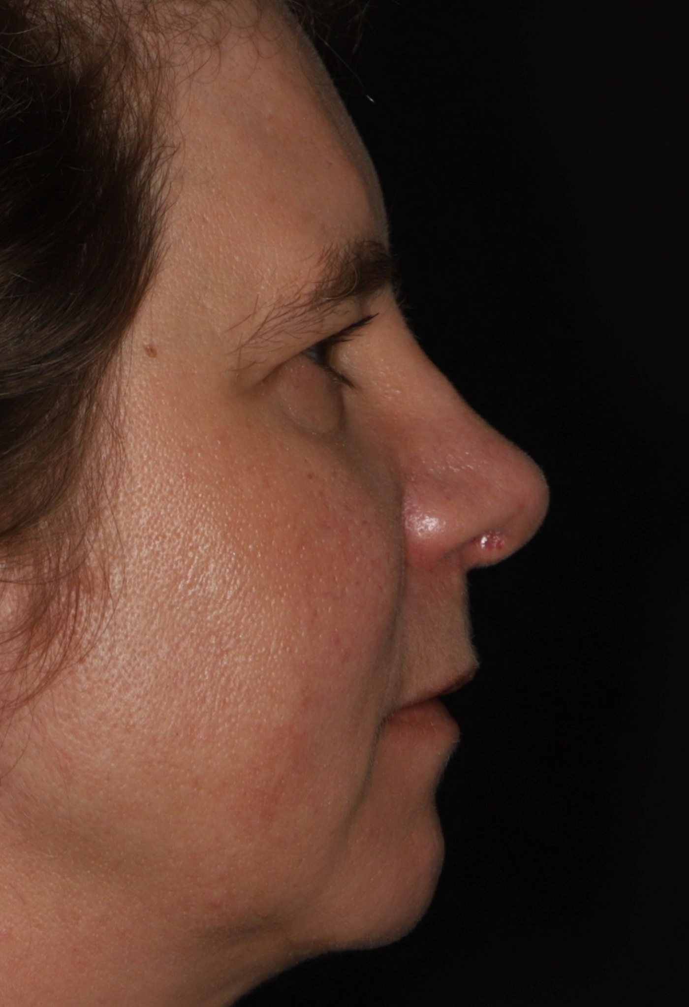 Decrease in projection of the nasal tip