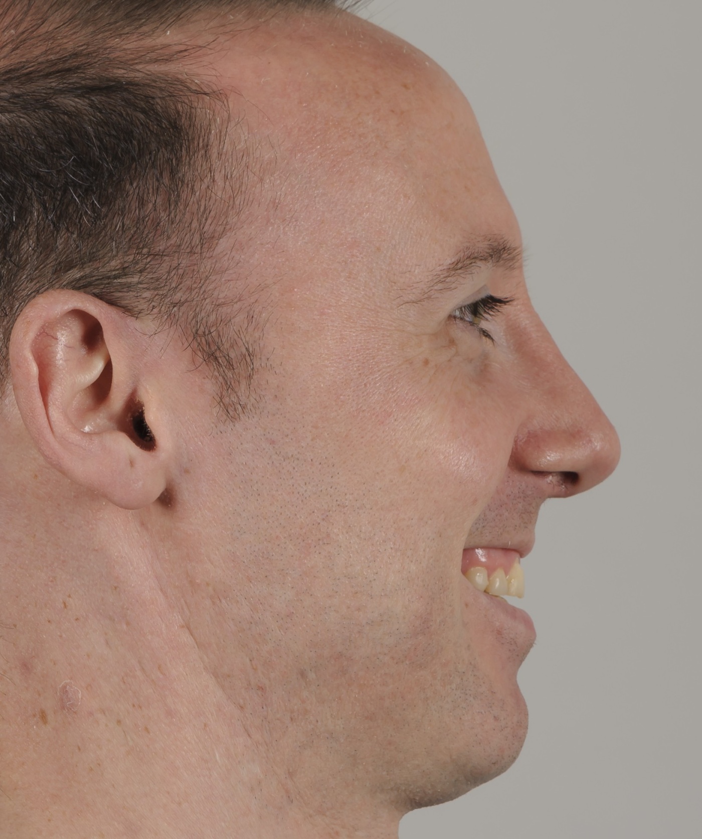 Secondary surgery and re-do of the nose