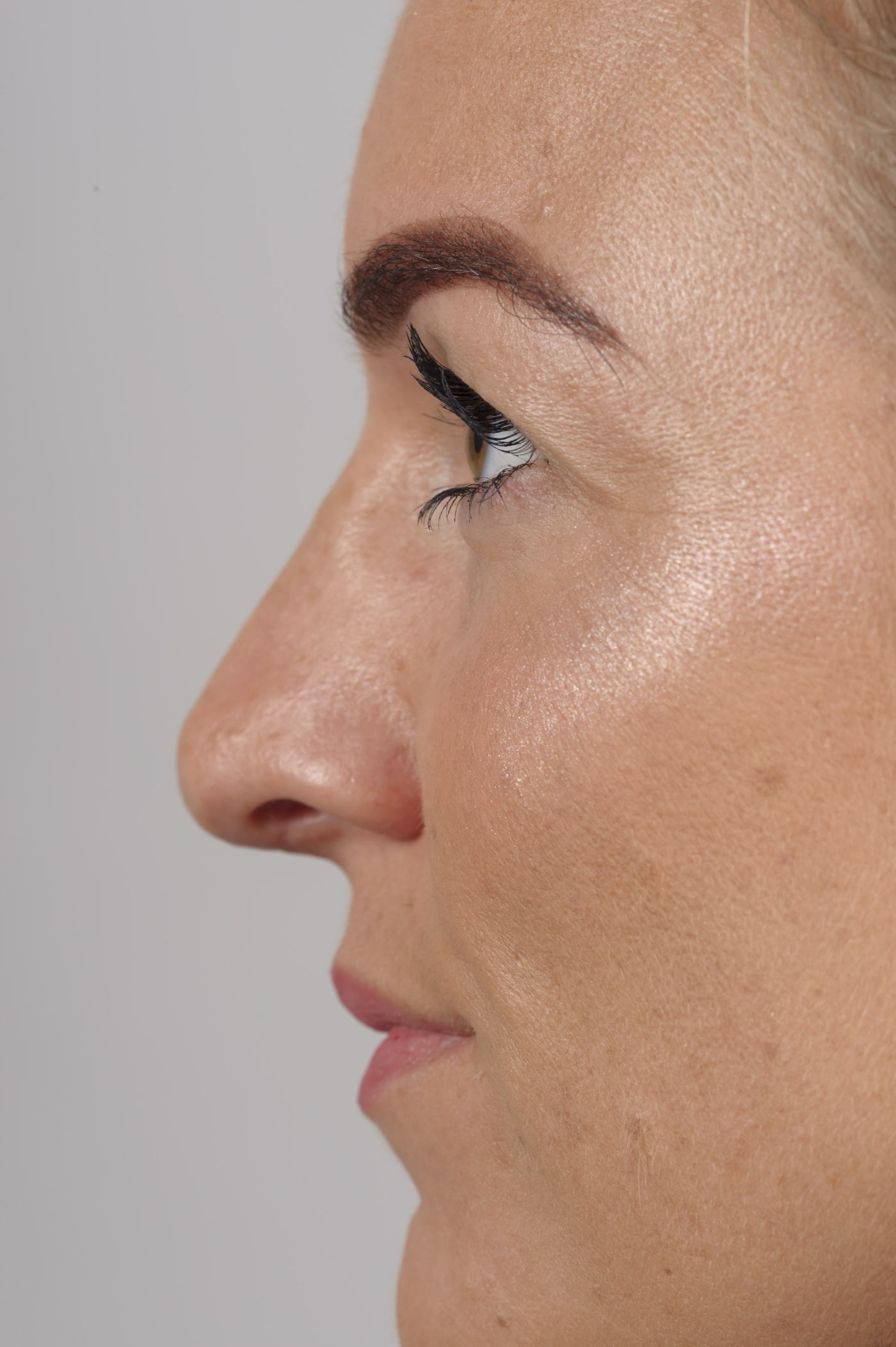 Upwards tilting of the tip of the nose