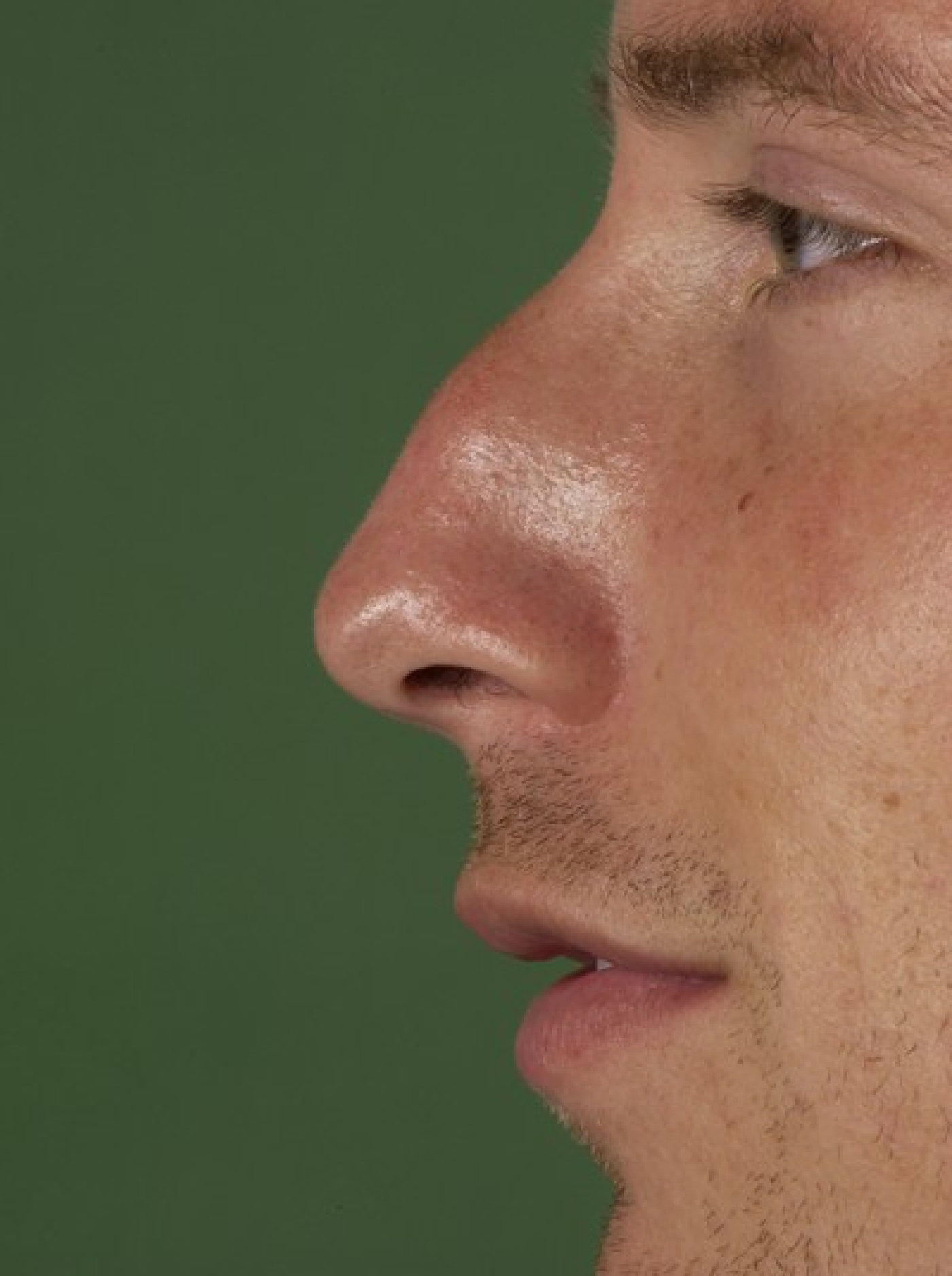 Reduction of a dorsal hump