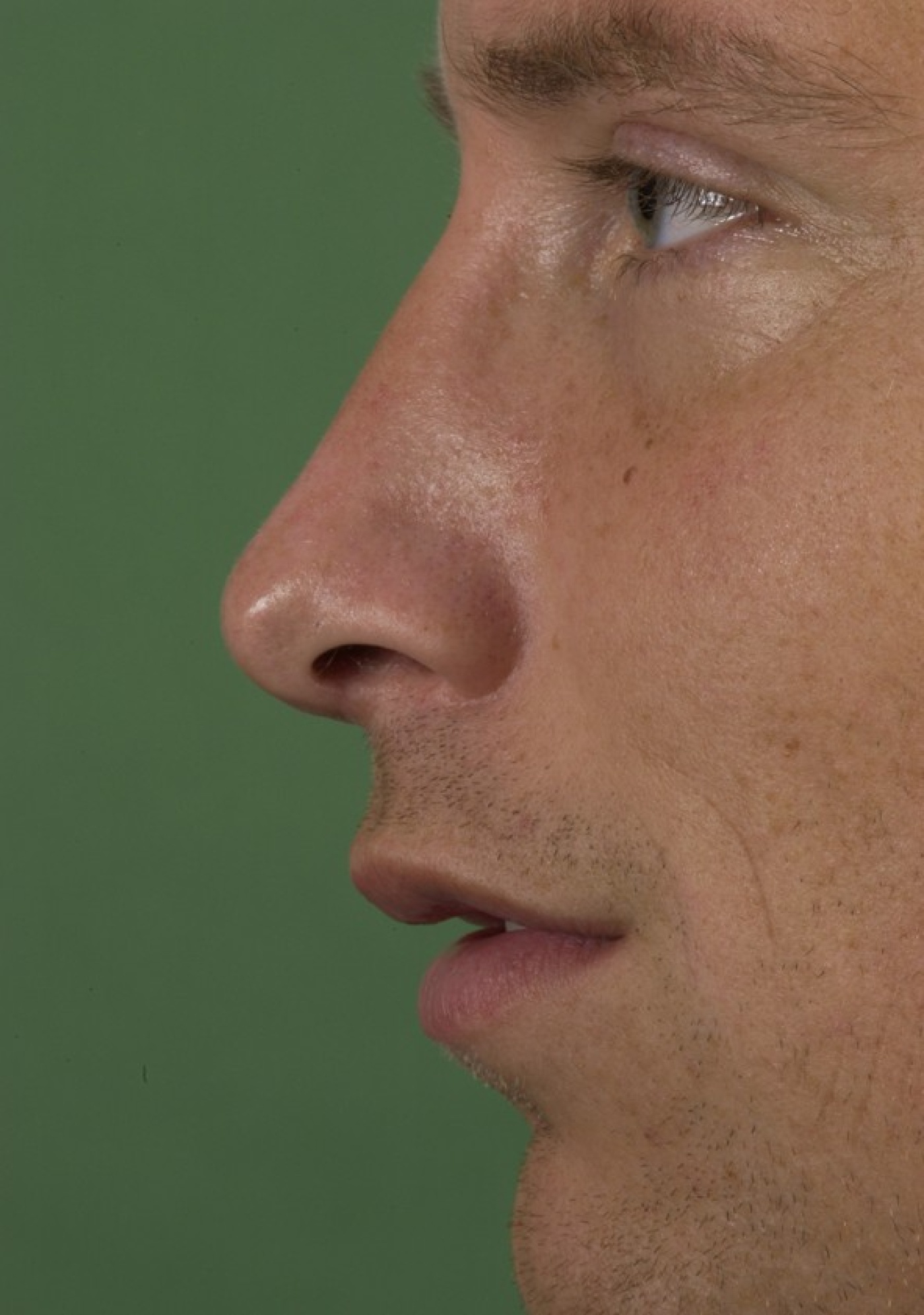 Reduction of a dorsal hump