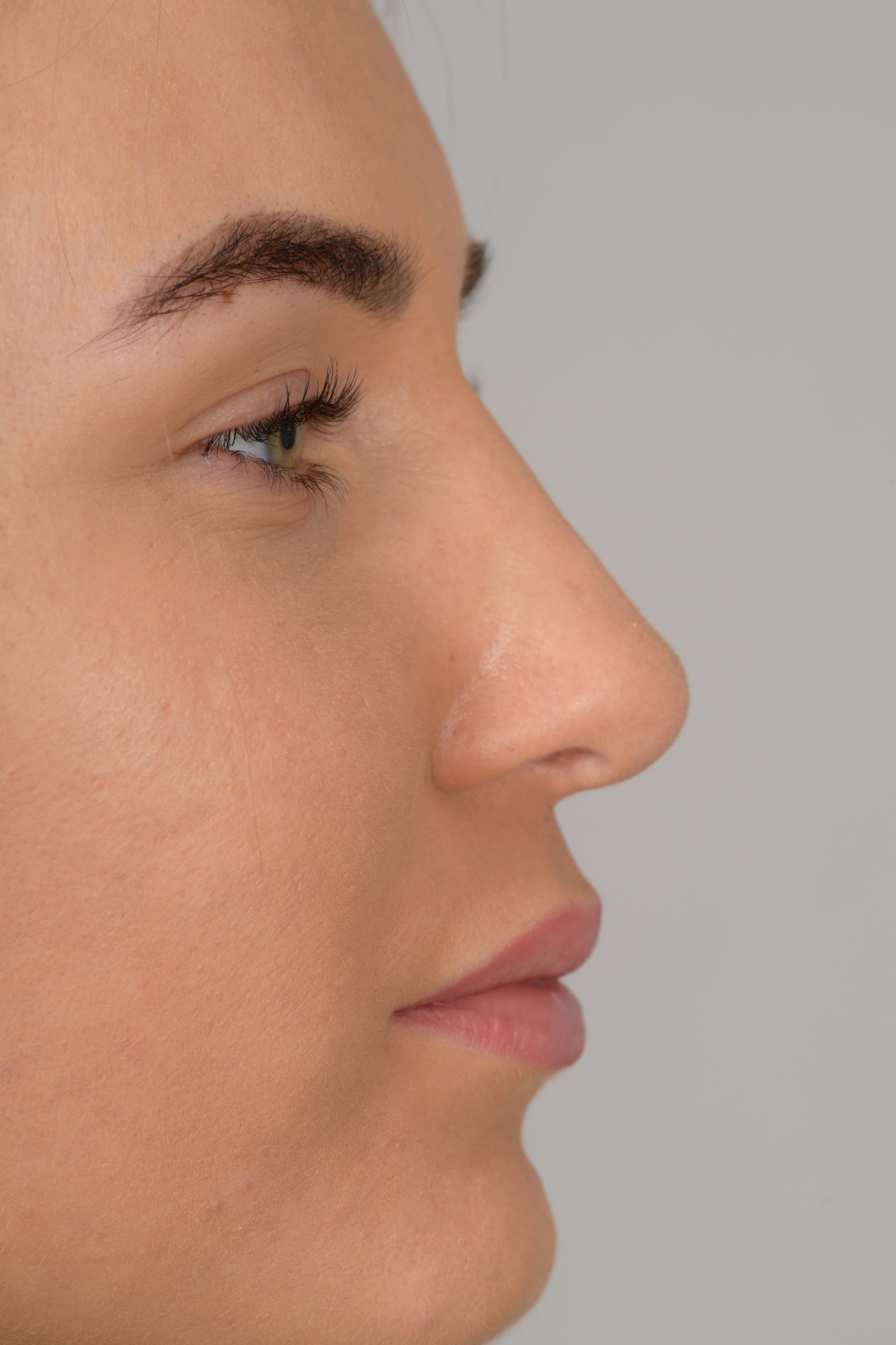 Extensive correction of the bridge, the tip and the septum