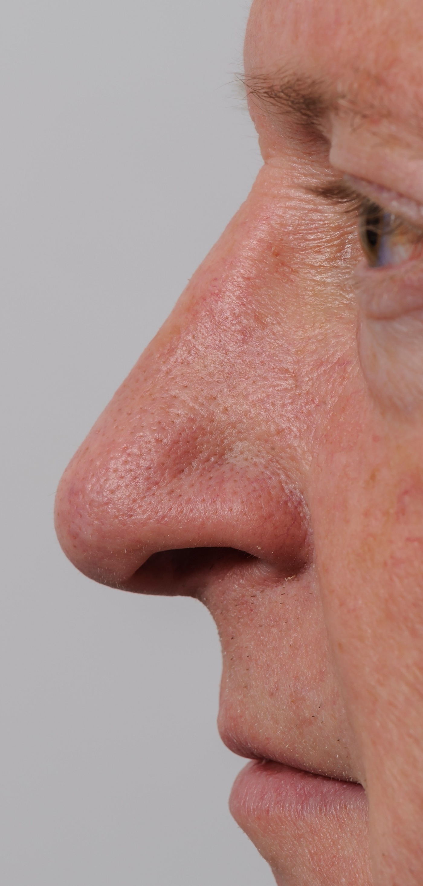 Straightening of the dorsum and upward rotation of the tip os the nose