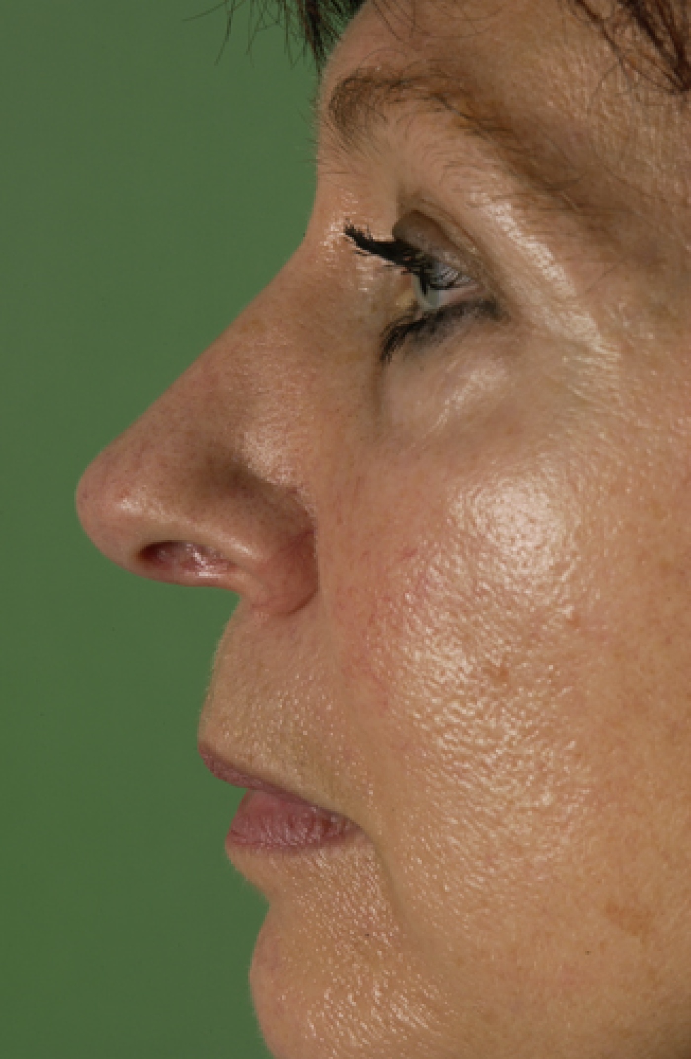 Refining the tip by reduction of the tip cartilages
