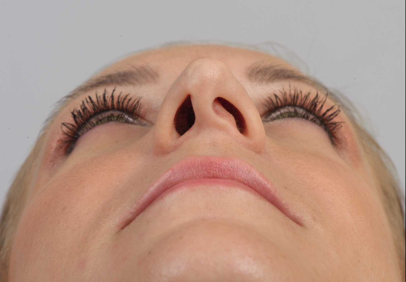 Correction of the deviated septum