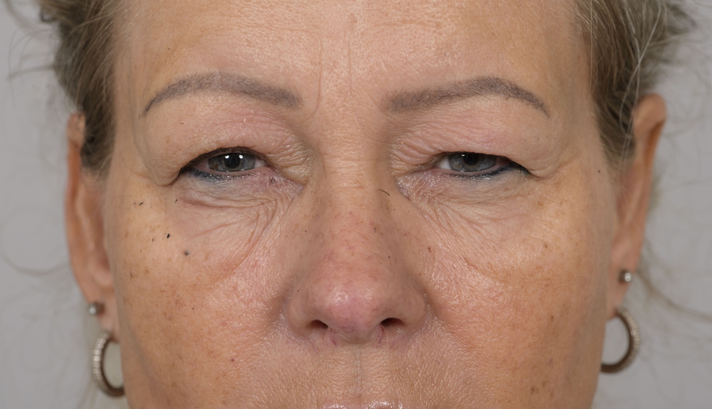 Shortening of the muscle that raises the upper eyelid (ptosis)