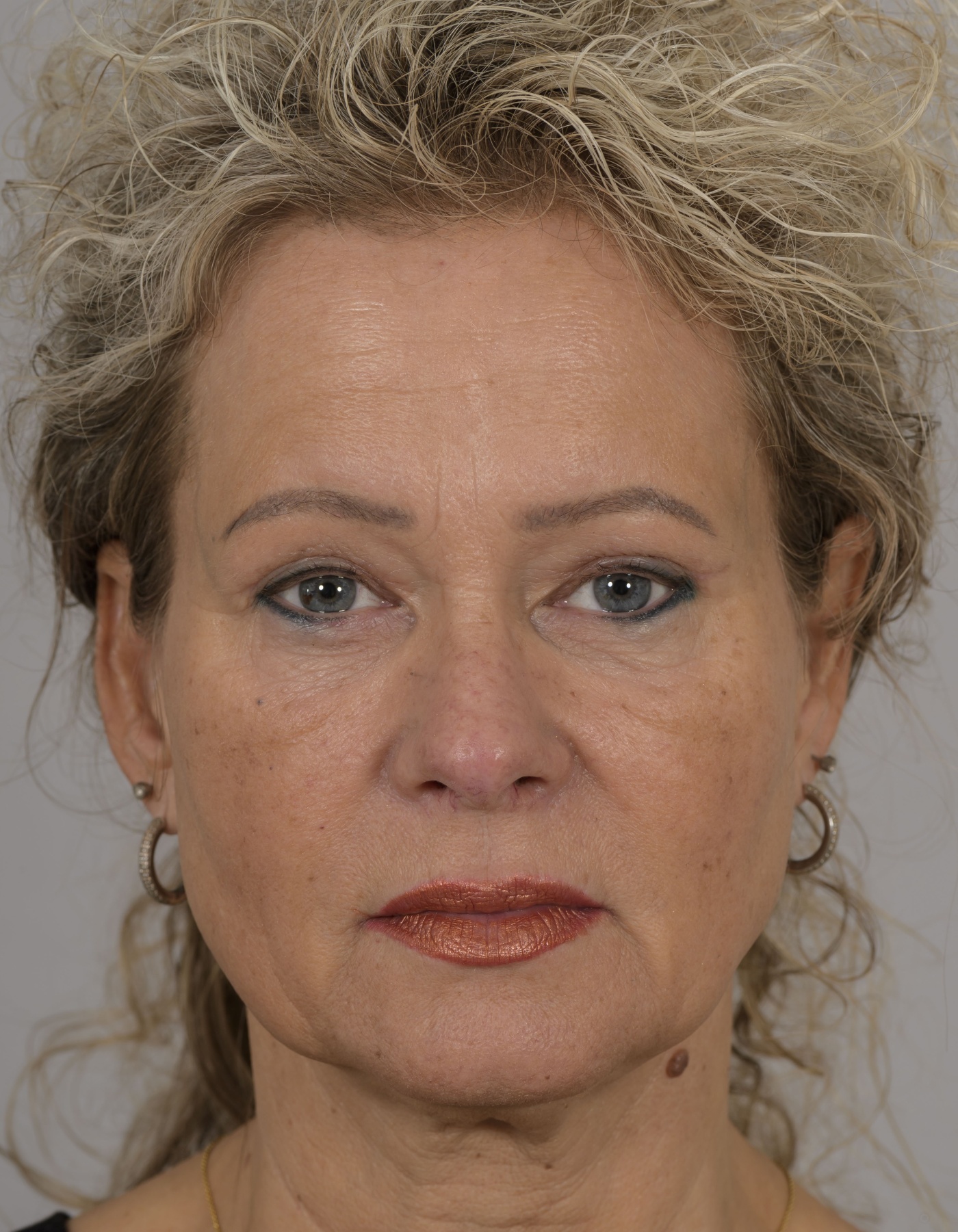 Correctie van de bovenoogleden met inkorten van de levator-spier