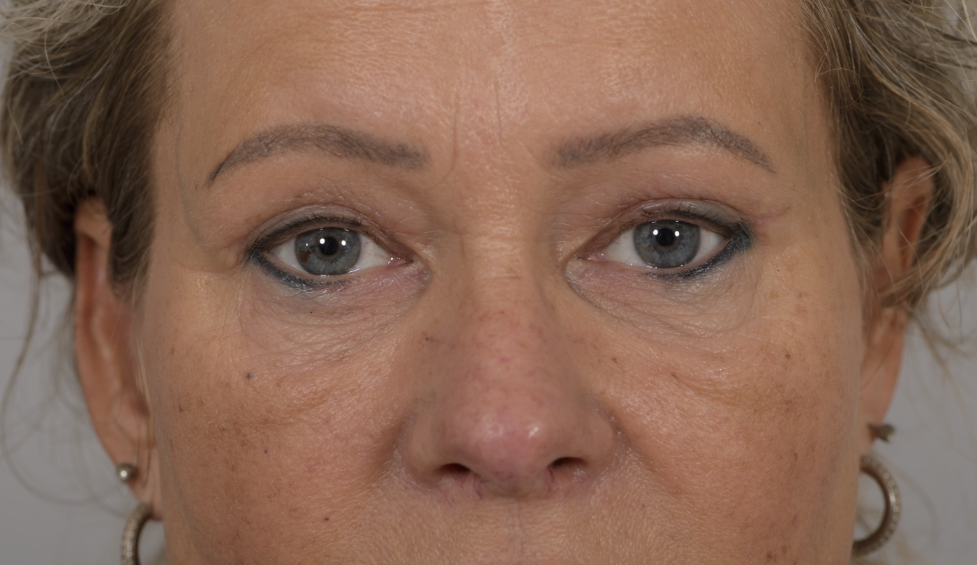 Bovenooglidcorrectie met inkorten van de spier, die het ooglid optrekt (ptosis)