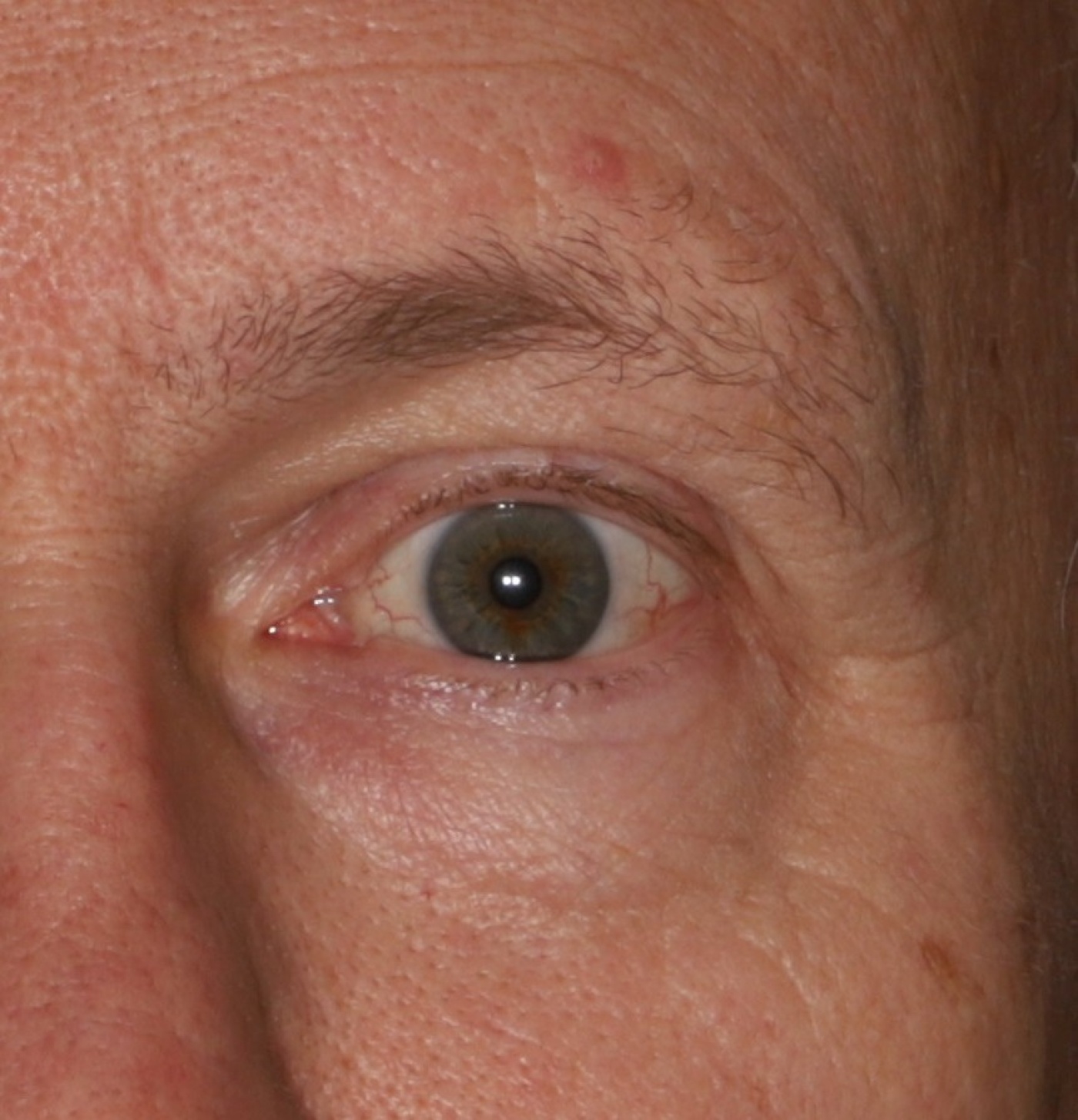 Rejuvenation of the eyelid by repositioning of the "lid-cheek junction"