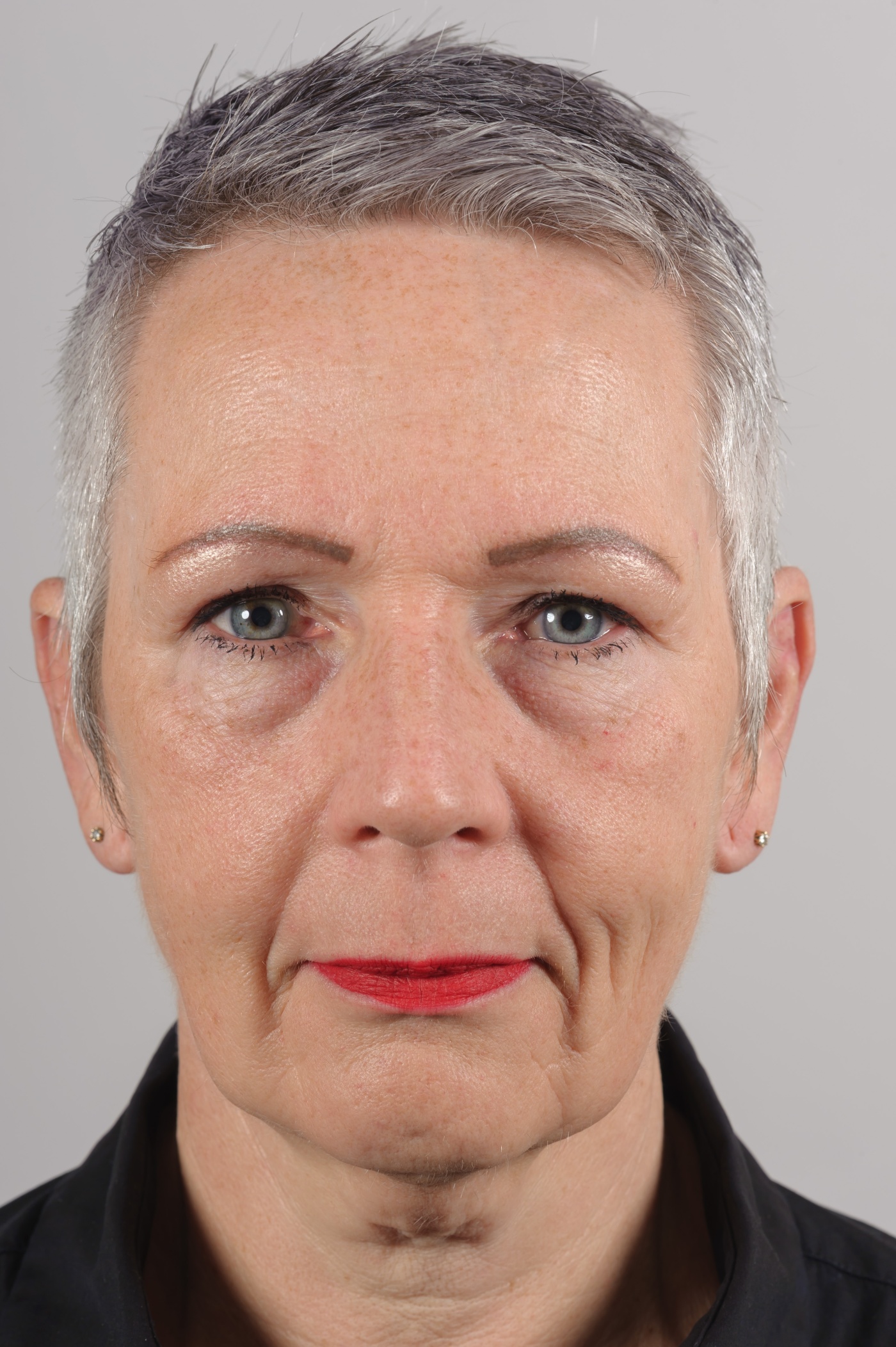 Correction of protruding ears in an adult