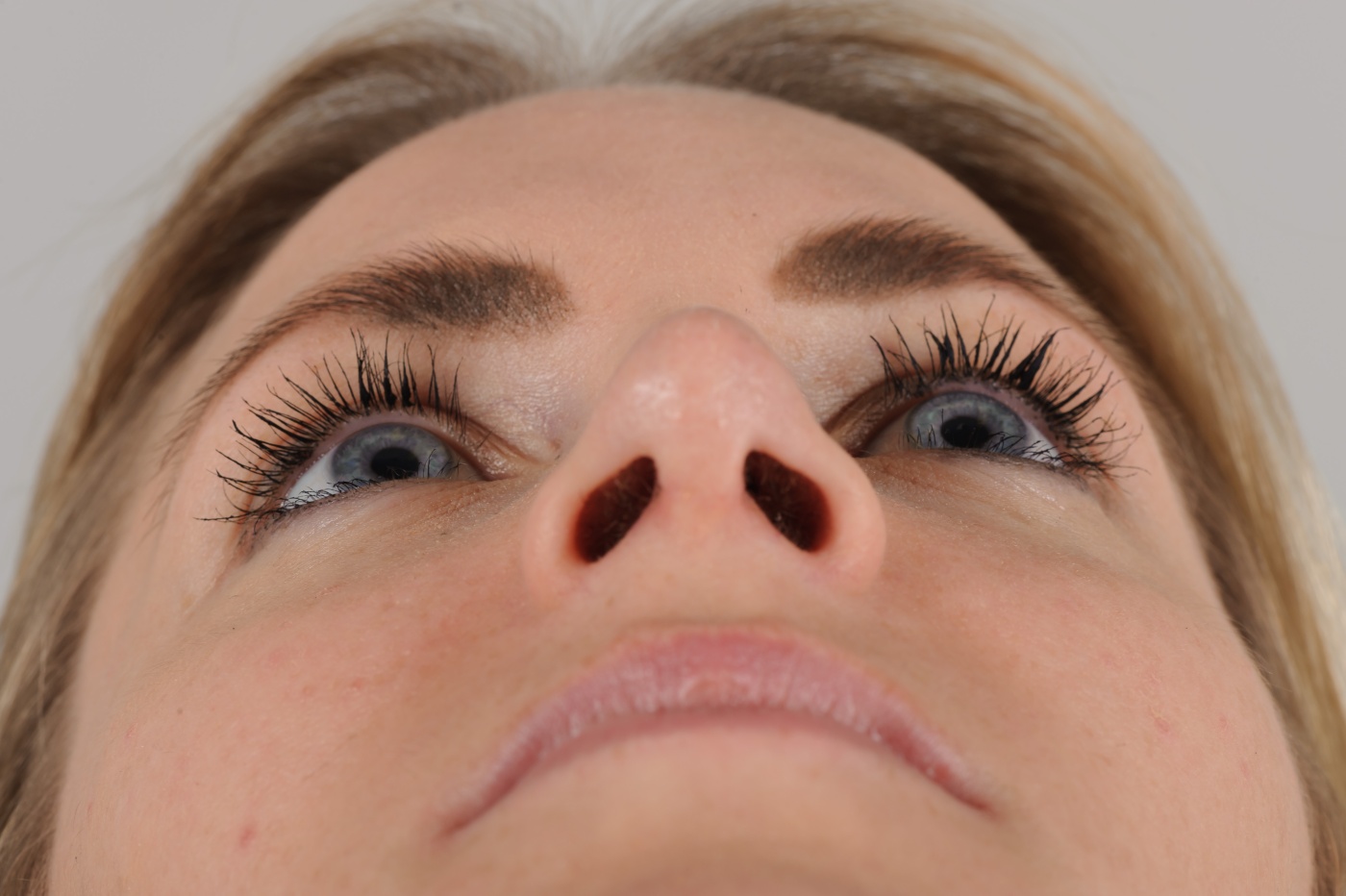 Decrease in projection of the nasal tip relaxes the nostrils
