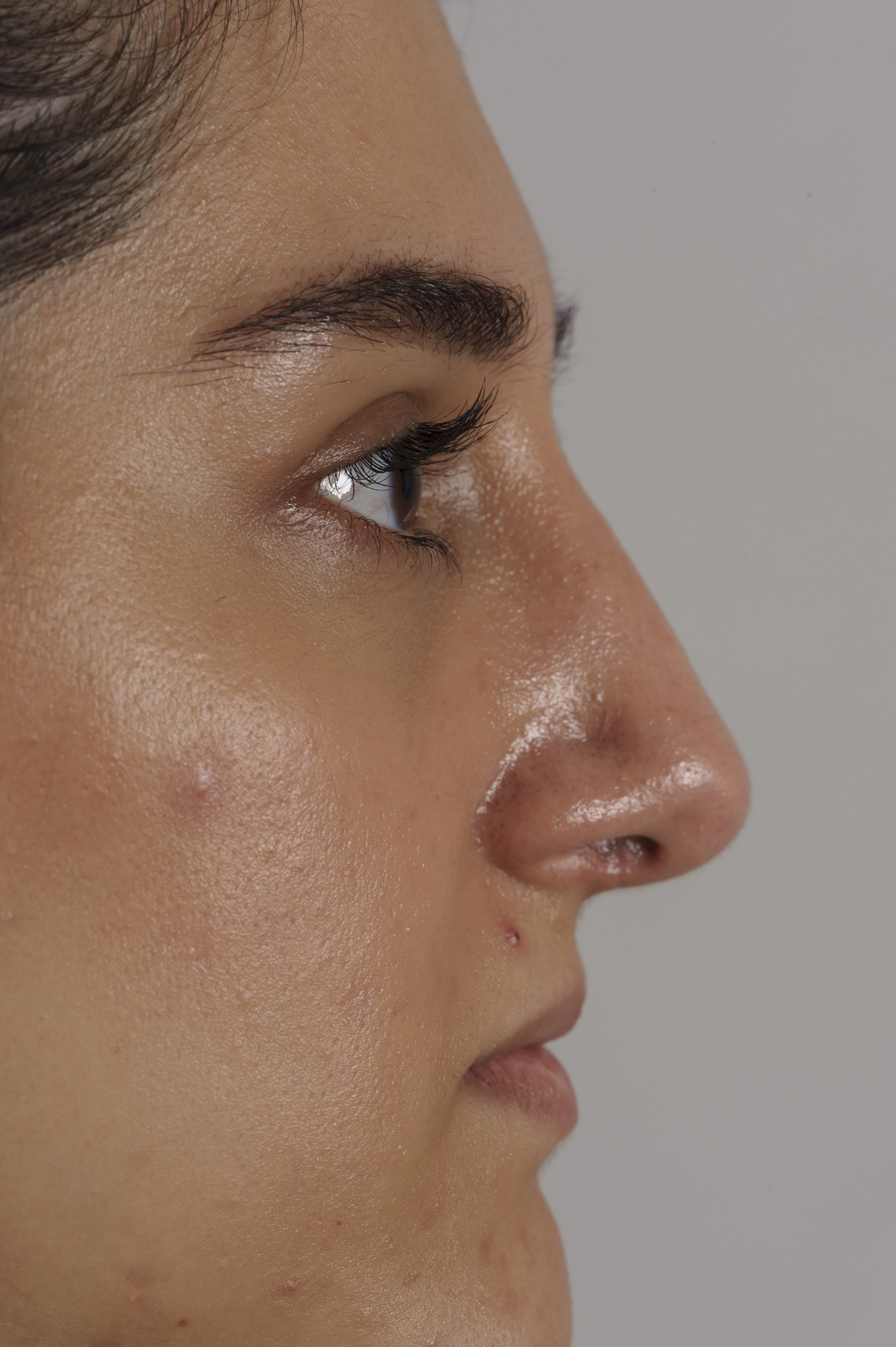 Lowering and narrowing the bridge of the nose and refining the nasal tip