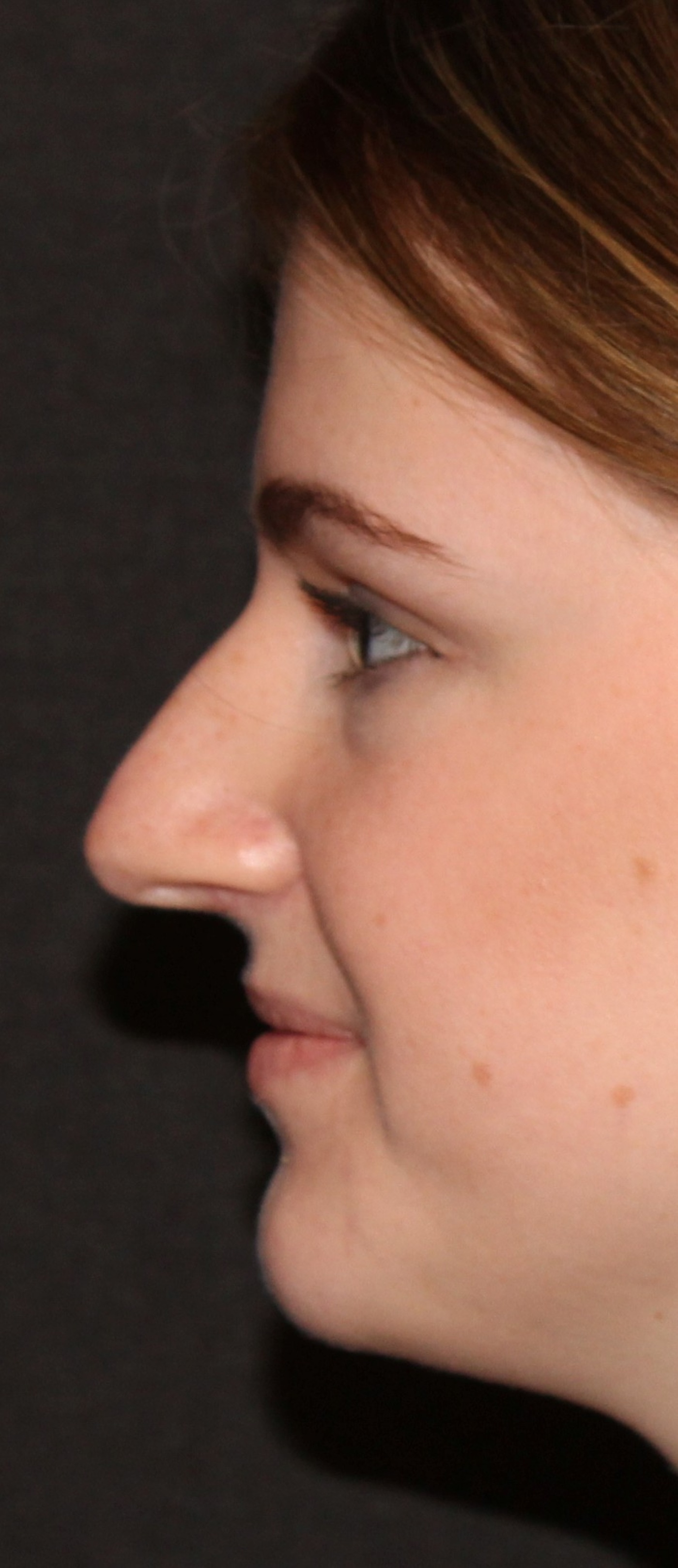 Reduction of the nose