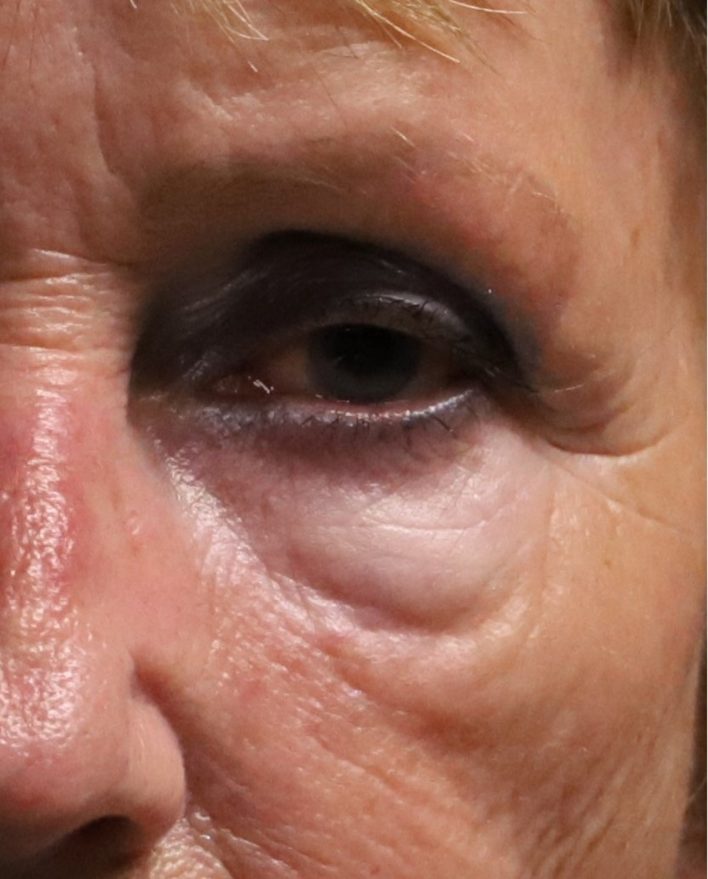 vet verwijderen en verplaatsen via de buitenzijde van de onderoogleden close-up(2).jpg