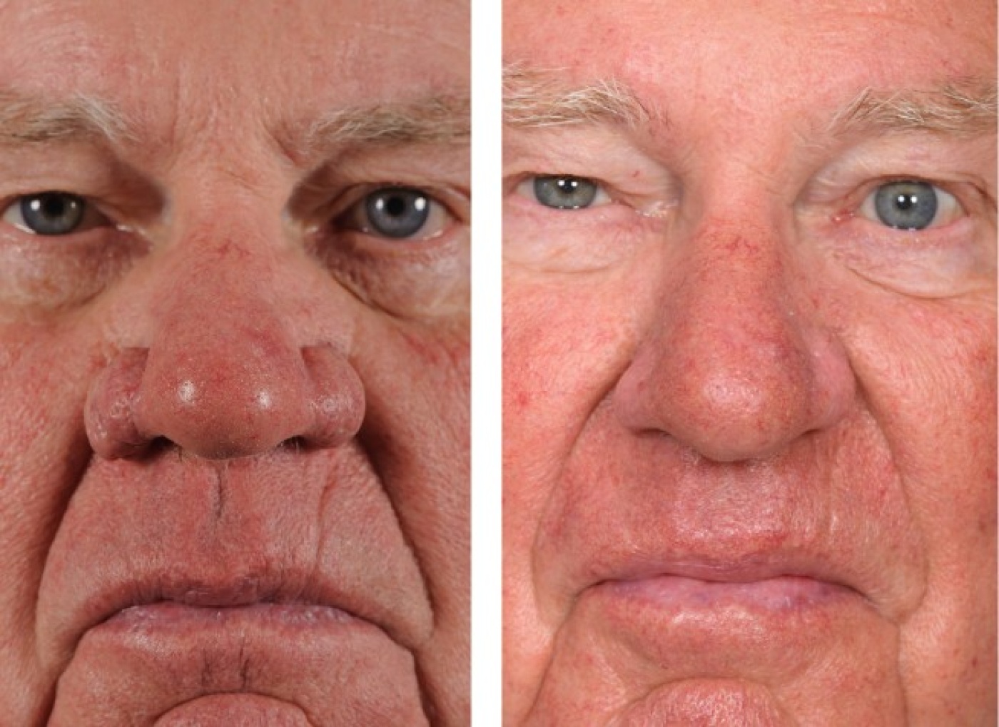 Rhinophyma of aardbeineus correctie Rhinophyma of aardbeineus correctie