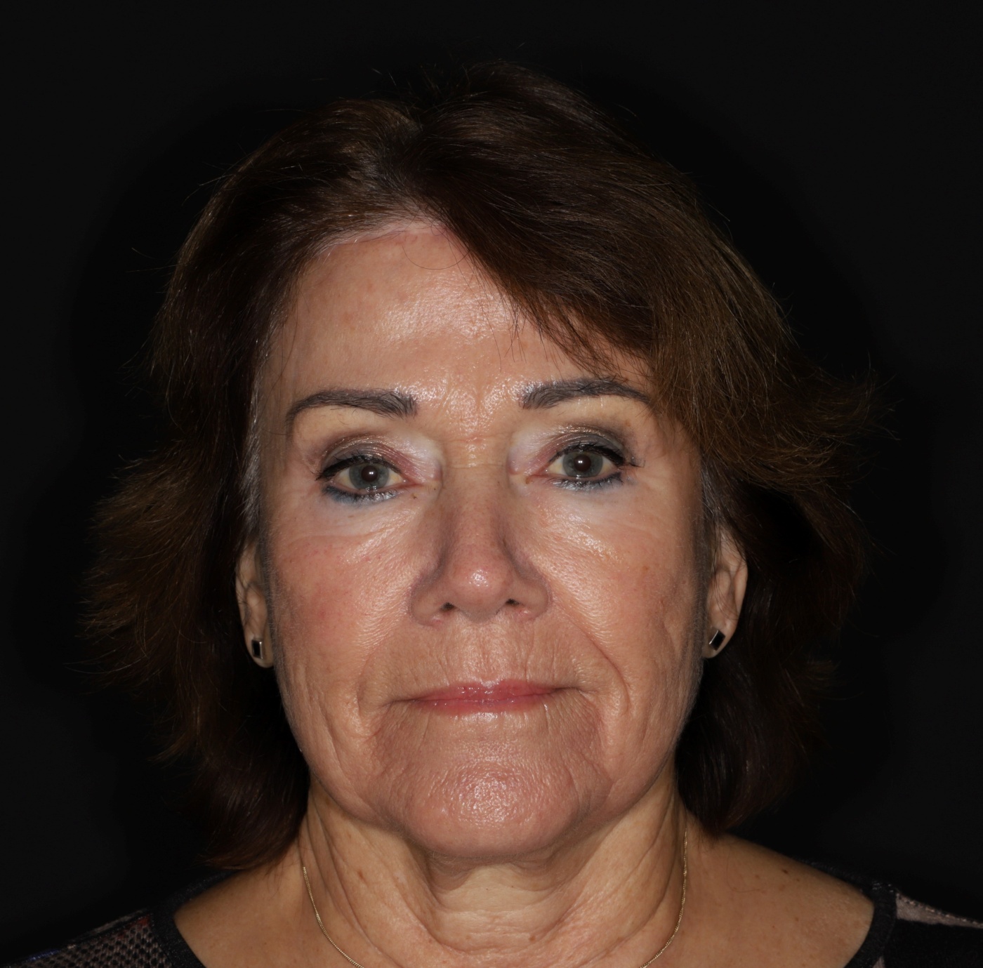 Forehead and browlift. An upper eyelid correction in this case would have resulted in a dark look