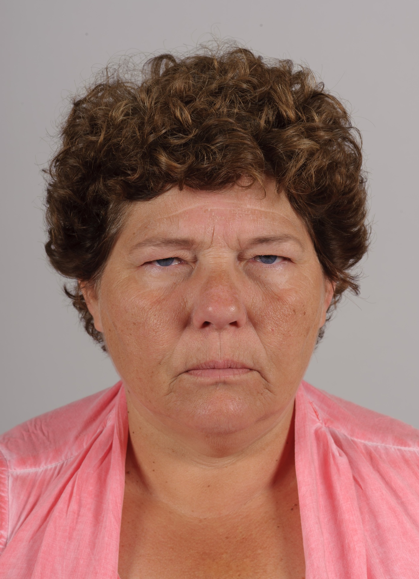 Extreme low eyebrows and headache