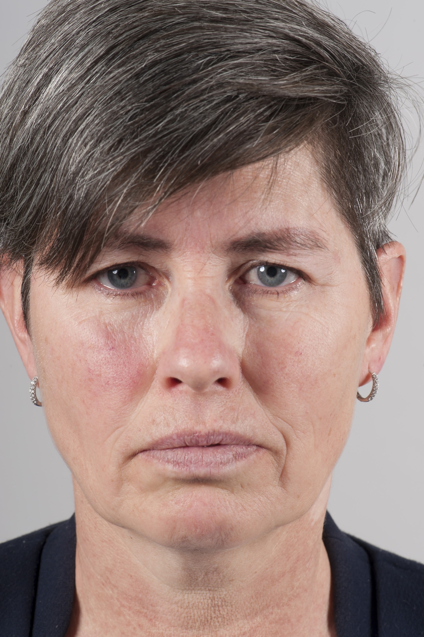 After the lift there is no more need for an eyelid correction. The scar of the forehead lift is placed at the hairline