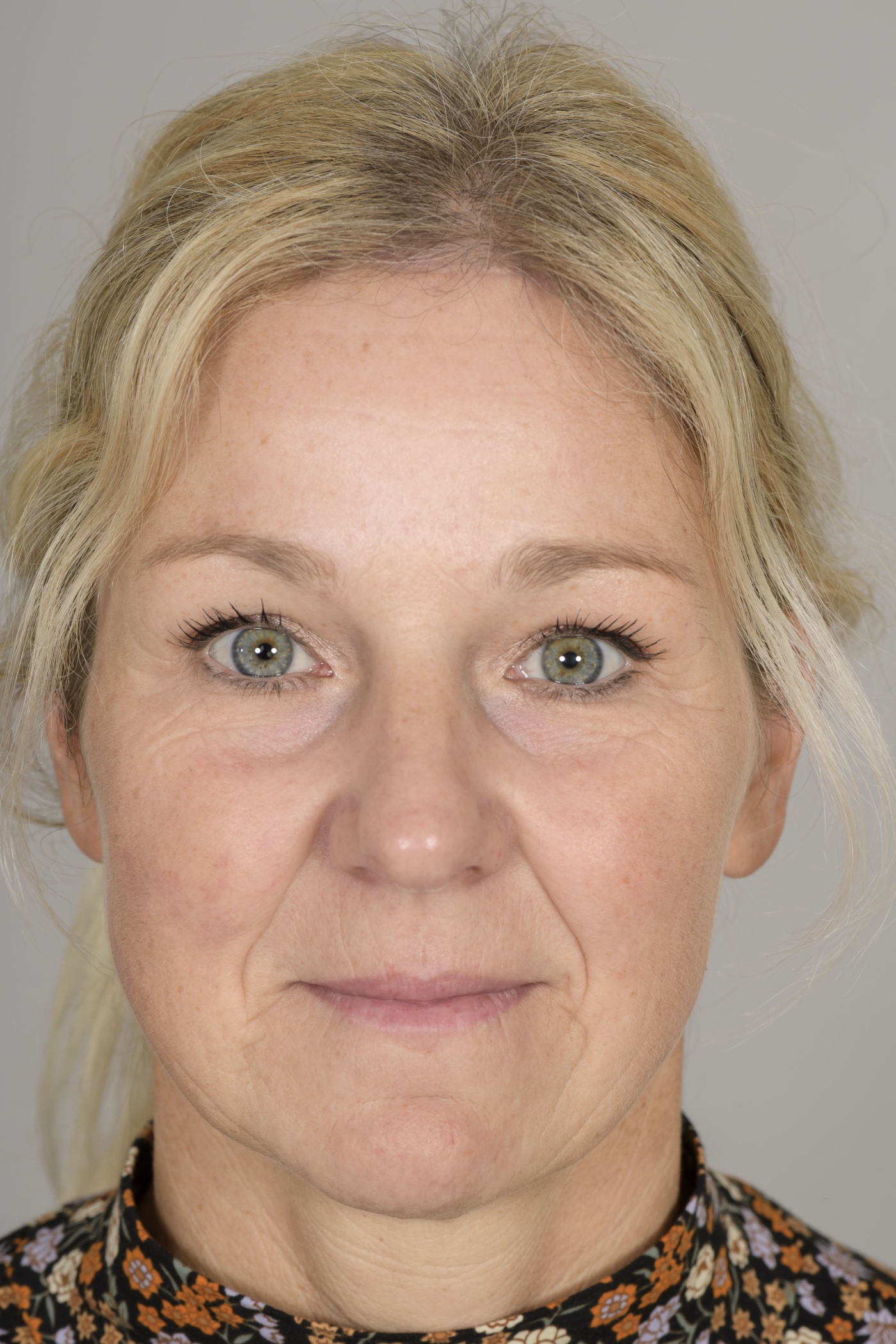 After the lift the forehead becomes shorter, has less wrinkles and is more relaxed