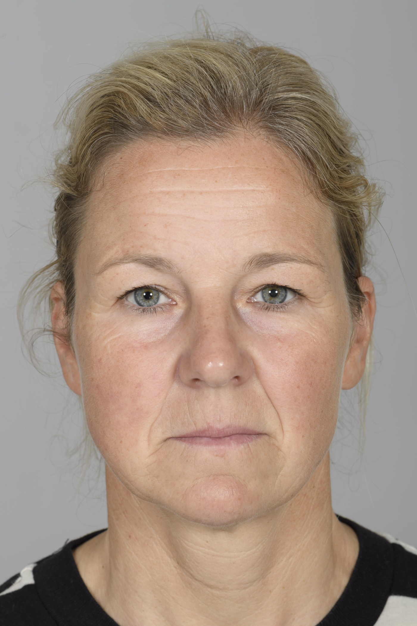 De esthetische winst van deze voorhoofdslift wordt gevormd door het kortere voorhoofd, de opener blik en het verdwijnen van de rimpels