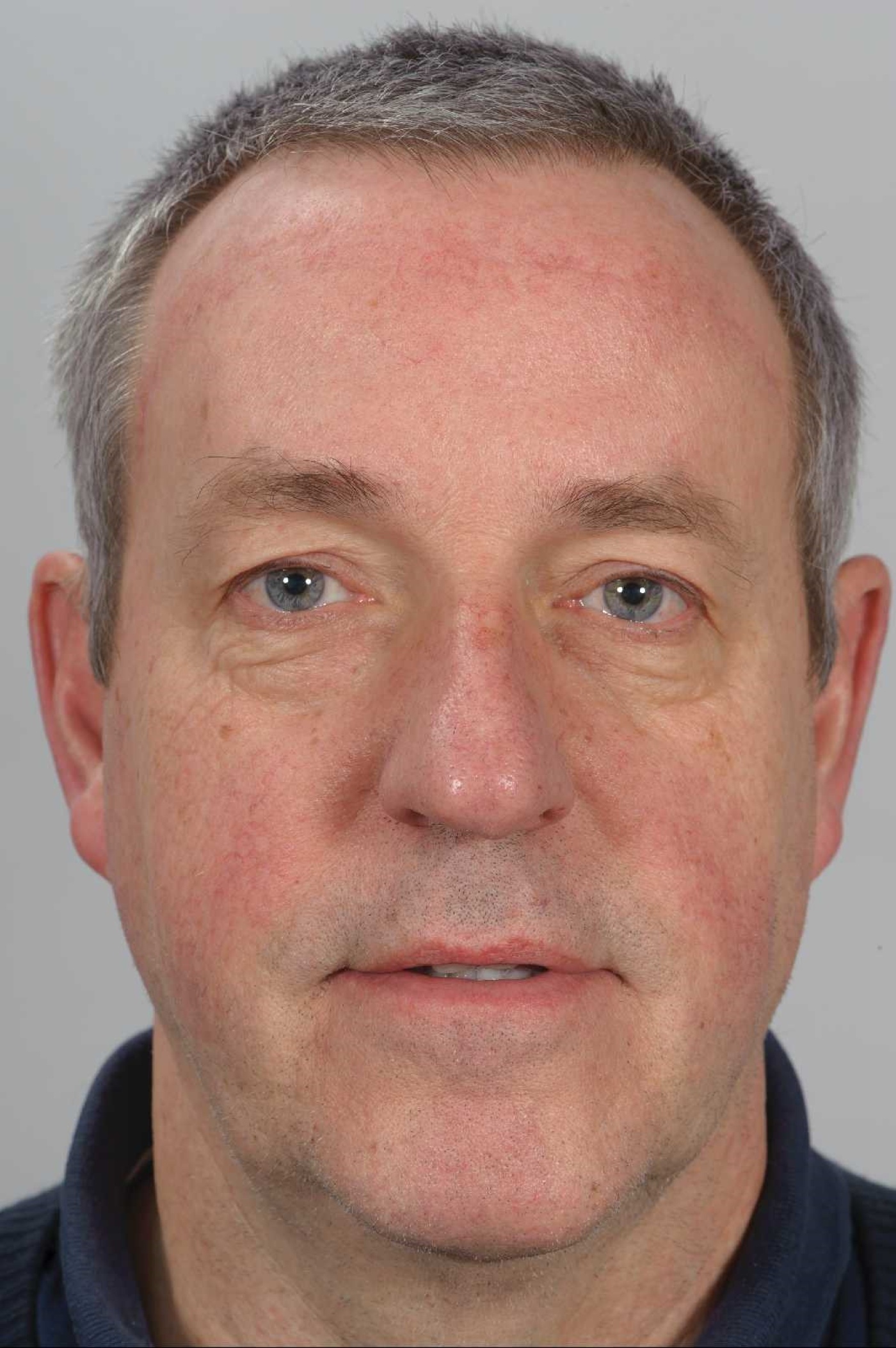 Voorhoofdslift bij een man met een terugtrekkende haargrens. Het litteken over het voorhoofd is na 3 maanden nog enigszins zichtbaar