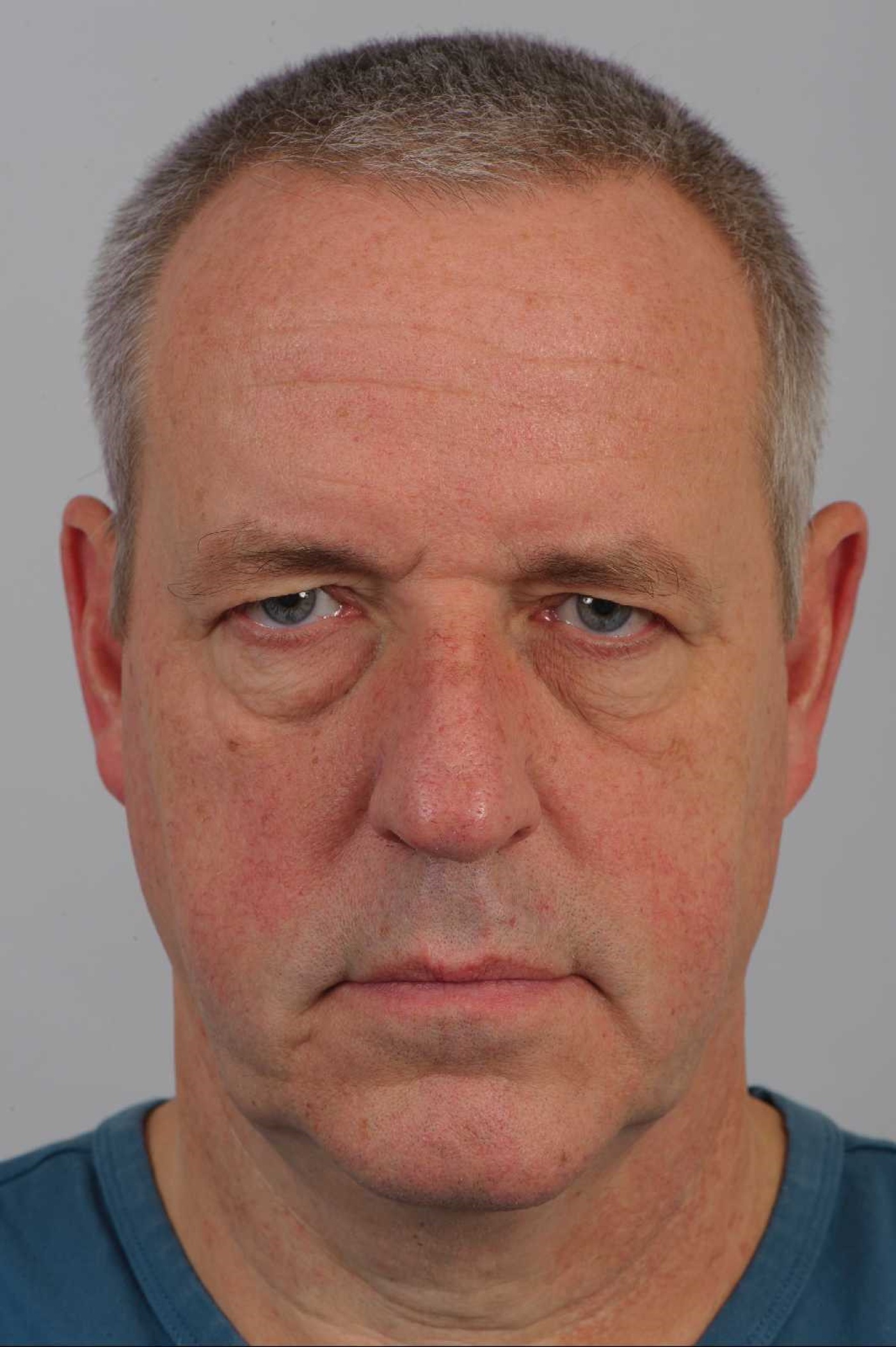 Forehead lift in a man with a receding hairline. The scar is placed over de forehead in the superior wrinkle