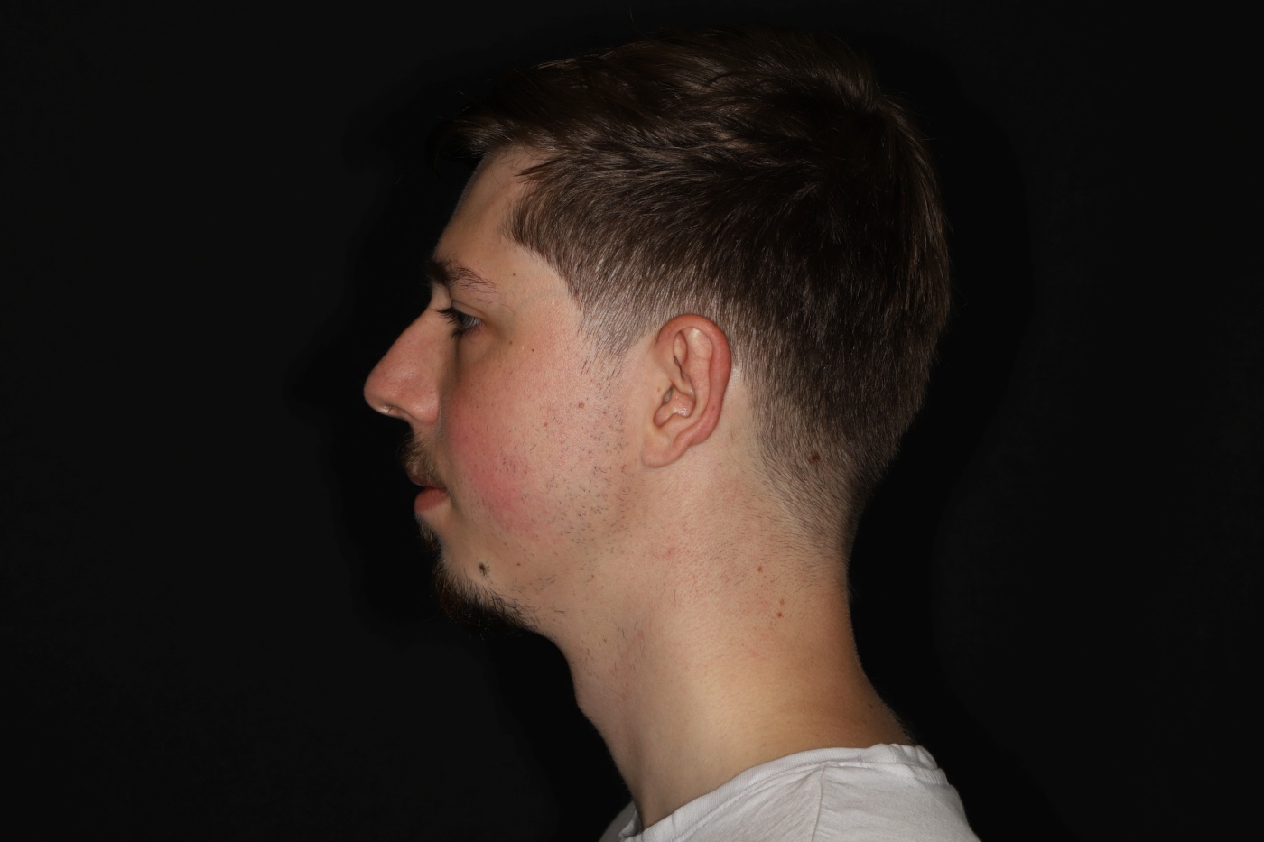 A stronger jawline after a chin implant